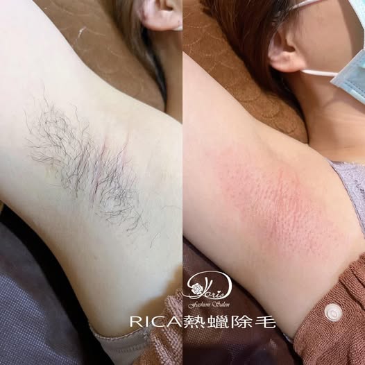 【台南除毛】想要肌膚透亮嫩白又能立即解決毛髮問題 熱蠟除毛就是最好的選擇